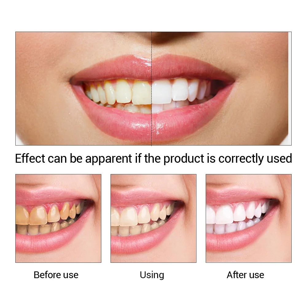 FTEENPLY Teeth Whitening Essen - огляд і ціна Teeth Whitening Street