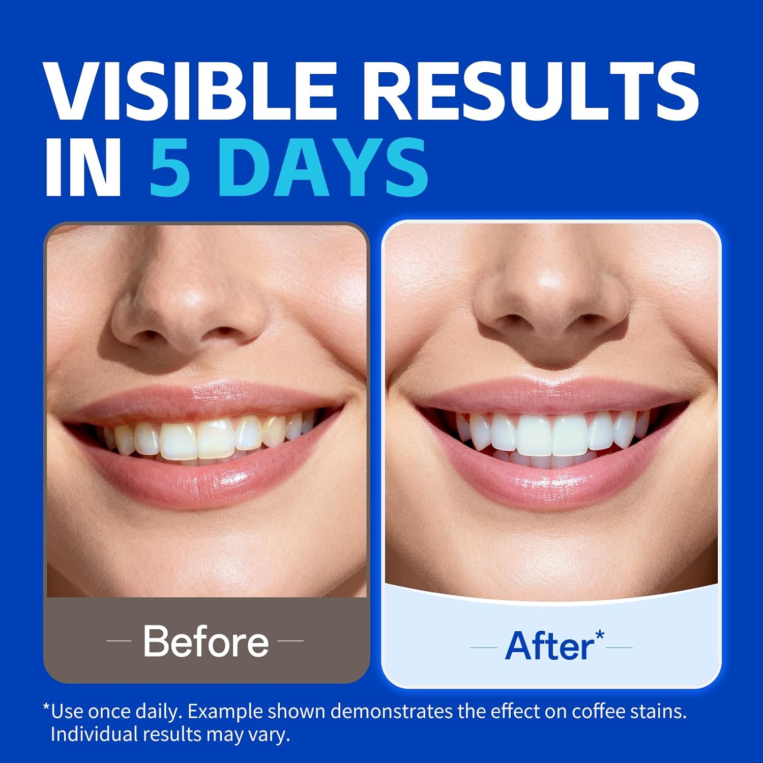 1/7 Pairs Teeth Whitening Stri - огляд і ціна Teeth Whitening Retainer