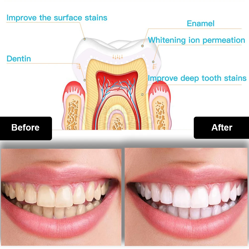 Dental Teeth Whitening Kit Min - огляд і ціна Teeth Whitening For Trays